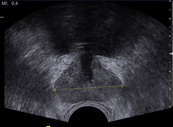 Gesunde Prostata im Ultraschall nach der Einnahme von Predstonorm