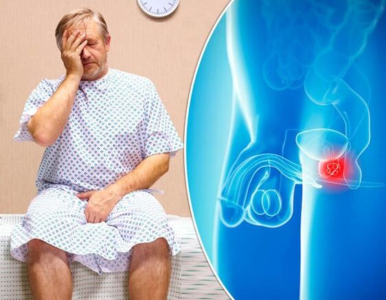 Prostatitis Symptome