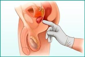Prostata -Palpation