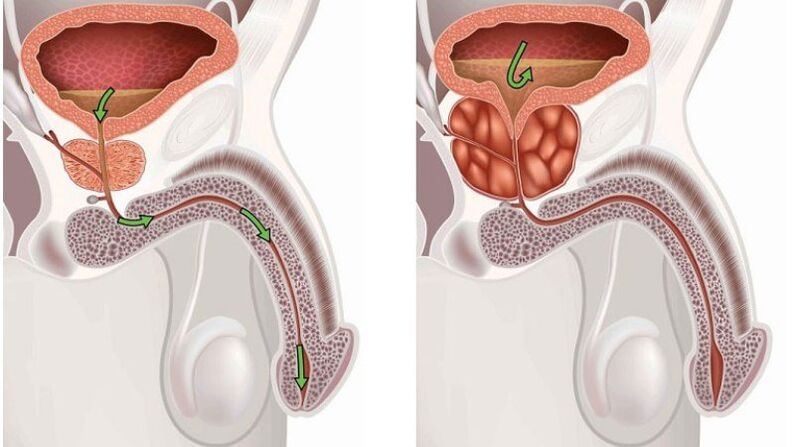 Gesunde und entzündete Prostata mit Prostatitis.